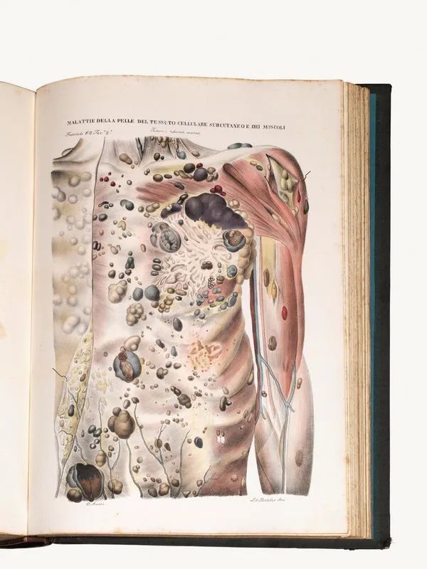 (Anatomia patologica&nbsp; Illustrati 800) CRUVEILHIER, Jean (1791-1874).&nbsp;&nbsp;&nbsp;&nbsp;&nbsp;&nbsp;  - Asta Stampe e disegni antichi e moderni-Libri Antichi - Pandolfini Casa d'Aste
